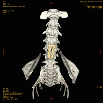 tabilisation du rachis cervical hernie cervicale